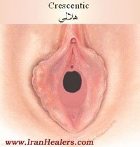  محل پرده بکارت هایمن با عکس