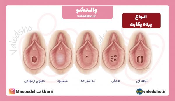  محل پرده بکارت هایمن با عکس