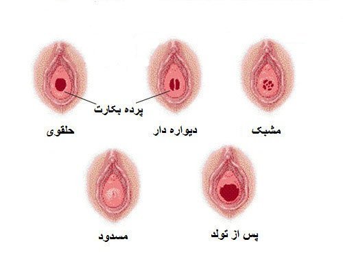  وقتی پرده زده میشه (پرده بکارت) چقدر خون میاد