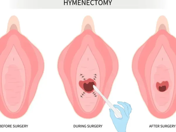  وقتی پرده زده میشه (پرده بکارت) چقدر خون میاد