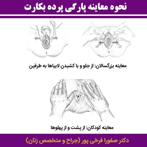  وقتی پرده زده میشه (پرده بکارت) چقدر خون میاد