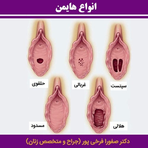  پاره گی پرده بکارت در اثر ورزش و خودارضایی