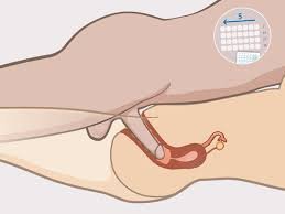  پاره گی پرده بکارت در اثر ورزش و خودارضایی
