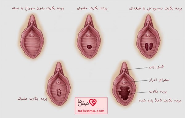  پاره گی پرده بکارت در اثر ورزش و خودارضایی