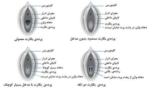  پاره گی پرده بکارت در اثر ورزش و خودارضایی