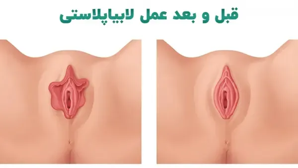  از کجا بفهمیم واژن تنگی داریم