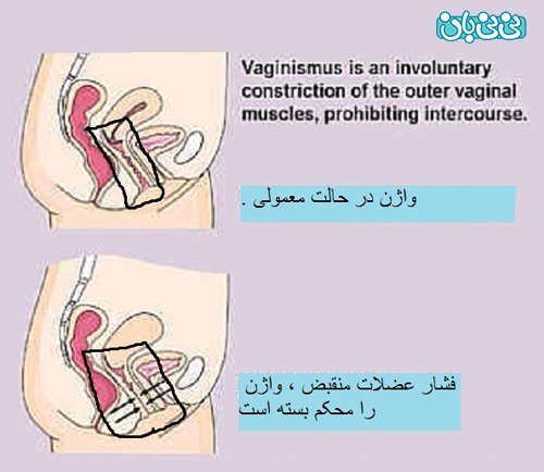  از کجا بفهمیم واژن تنگی داریم
