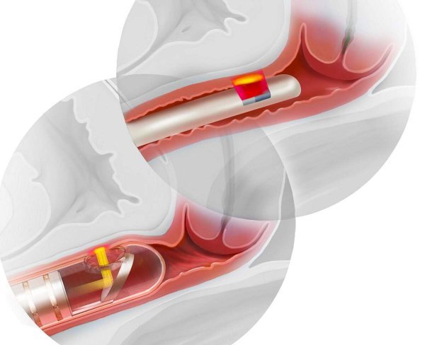  فیلم درمان واژینیسموس با آر اف + هزینه درمان واژینیسموس با آر اف