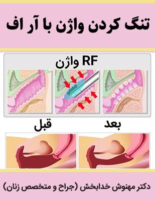  فیلم درمان واژینیسموس با آر اف + هزینه درمان واژینیسموس با آر اف