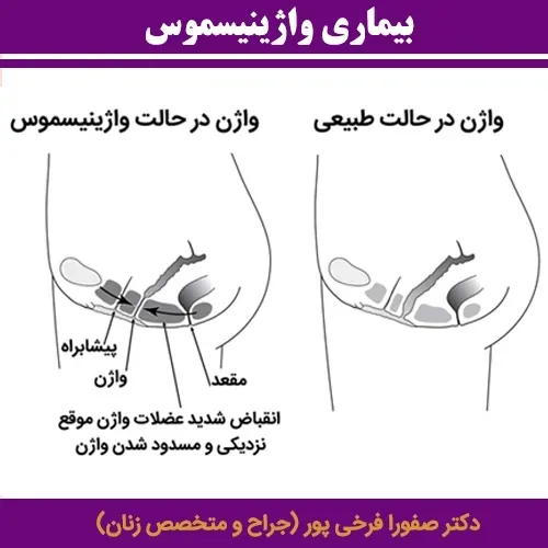  فیلم درمان واژینیسموس با آر اف + هزینه درمان واژینیسموس با آر اف