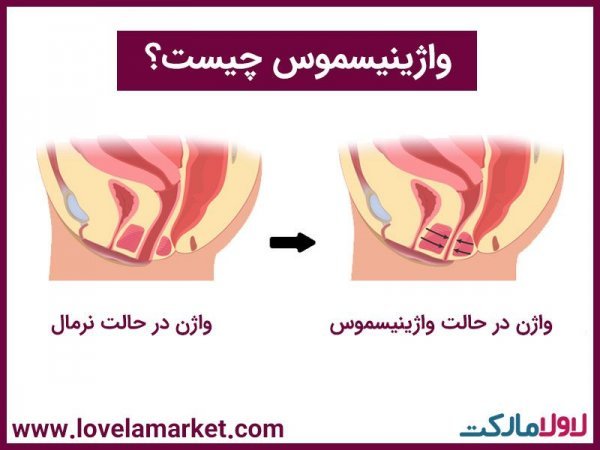 فیلم درمان واژینیسموس با آر اف + هزینه درمان واژینیسموس با آر اف