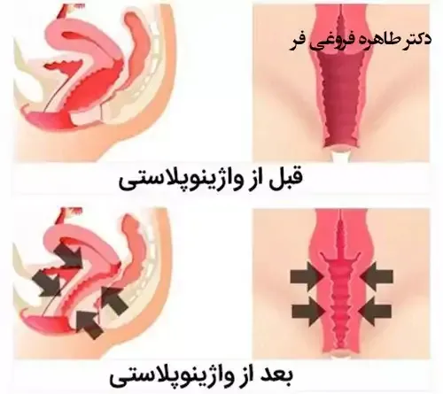  برای زیبایی / جوانسازی ناحیه تناسلی / واژن چه کنیم؟