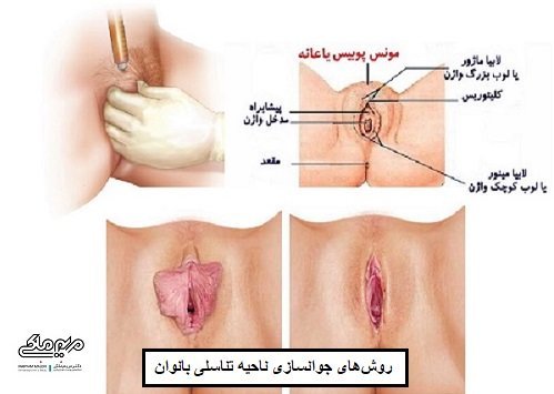  برای زیبایی / جوانسازی ناحیه تناسلی / واژن چه کنیم؟