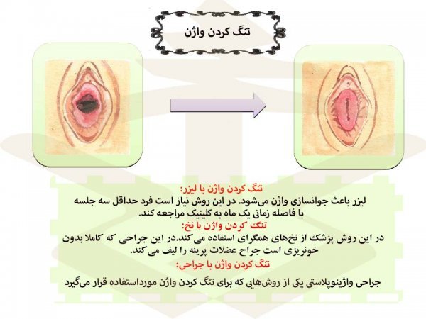  برای زیبایی / جوانسازی ناحیه تناسلی / واژن چه کنیم؟