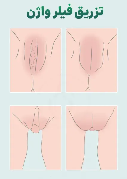  برای زیبایی / جوانسازی ناحیه تناسلی / واژن چه کنیم؟