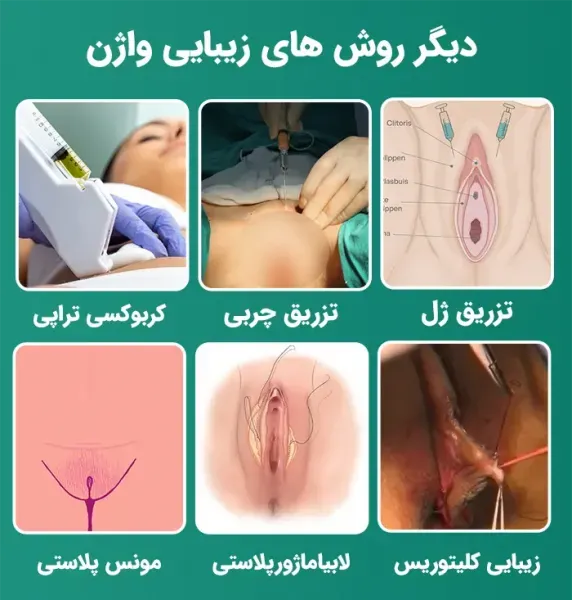 فیلم و عکس عمل زیبایی واژن با بخیه