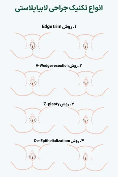  فیلم و عکس عمل زیبایی واژن با بخیه
