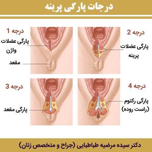  فیلم و عکس عمل زیبایی واژن با بخیه