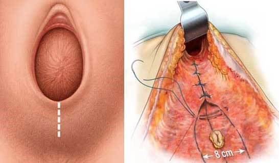  فیلم و عکس عمل زیبایی واژن با بخیه