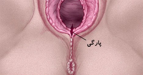  فیلم و عکس عمل زیبایی واژن با بخیه