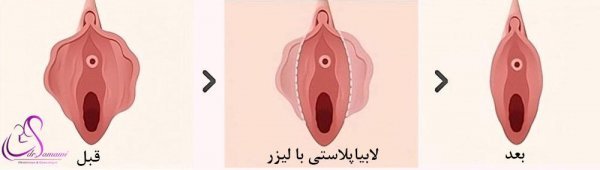  فیلم و عکس عمل زیبایی واژن با بخیه