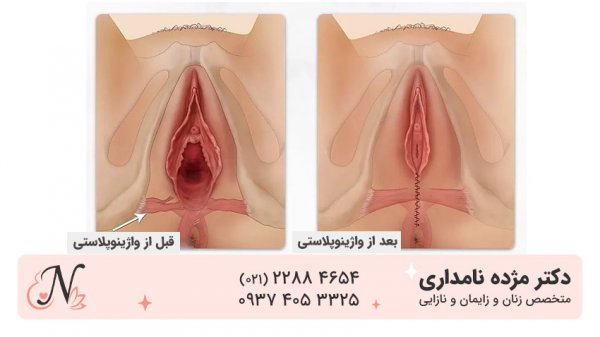  فیلم و عکس عمل زیبایی واژن با بخیه