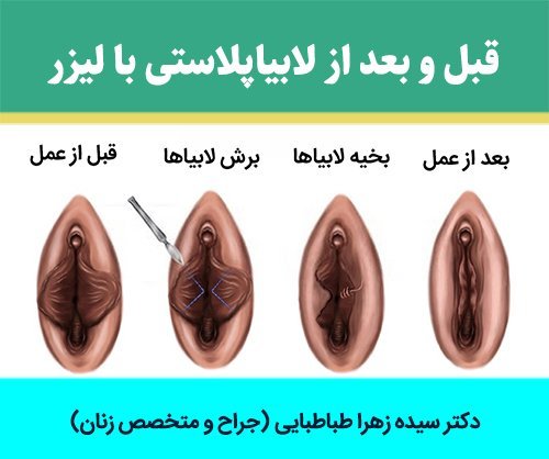  فیلم و عکس عمل زیبایی واژن با بخیه