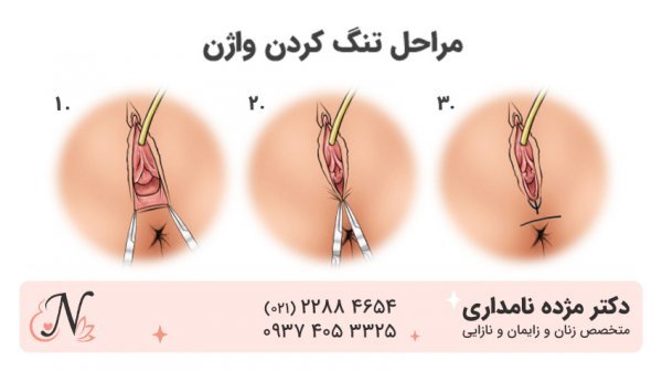  فیلم و عکس عمل زیبایی واژن با بخیه