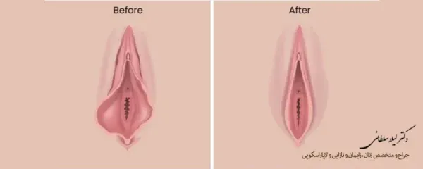  فیلم و عکس عمل زیبایی واژن با بخیه