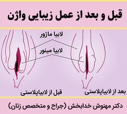  فیلم و عکس عمل زیبایی واژن با بخیه