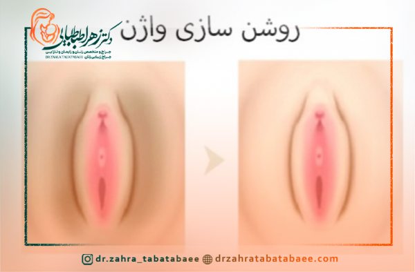 عکس قبل و بعد لیزر سفید کننده واژن+لیزر مونالیزا