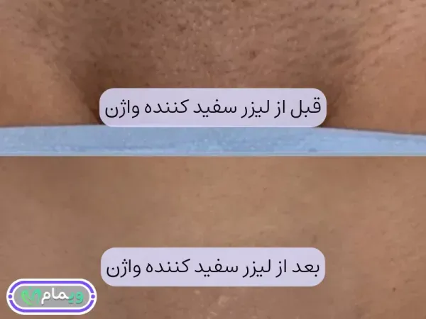  عکس قبل و بعد لیزر سفید کننده واژن+لیزر مونالیزا