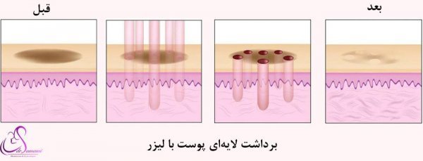  عکس قبل و بعد لیزر سفید کننده واژن+لیزر مونالیزا
