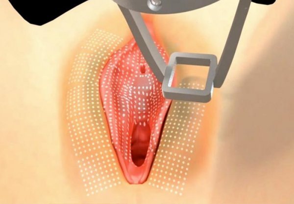  عکس قبل و بعد لیزر سفید کننده واژن+لیزر مونالیزا