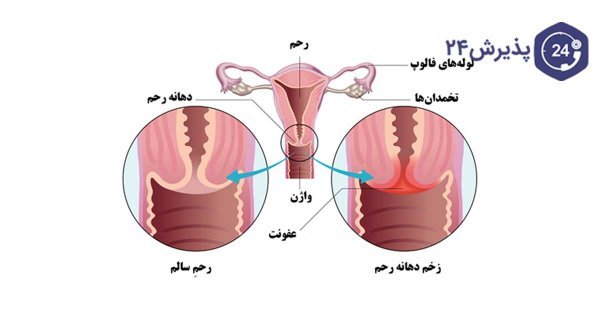  لیزر واژن بیکینی قبل و بعد