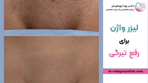  لیزر واژن بیکینی قبل و بعد