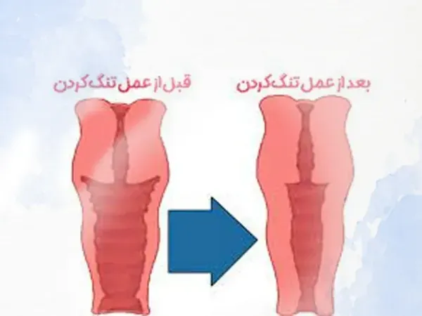  لیزر واژن بیکینی قبل و بعد
