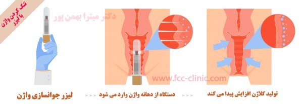  لیزر واژن بیکینی قبل و بعد