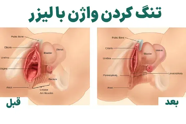  لیزر واژن بیکینی قبل و بعد