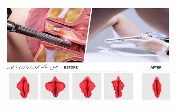 لیزر واژن بیکینی قبل و بعد