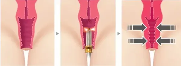  لیزر واژن بیکینی قبل و بعد