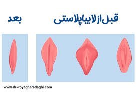 عکس و فیلم قبل و بعد از عمل لابیاپلاستی