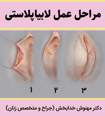  عکس و فیلم قبل و بعد از عمل لابیاپلاستی