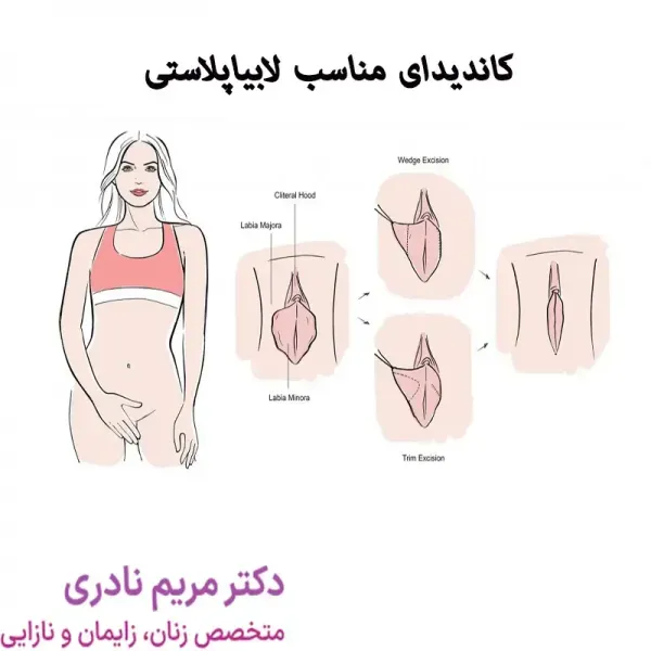  عکس و فیلم قبل و بعد از عمل لابیاپلاستی