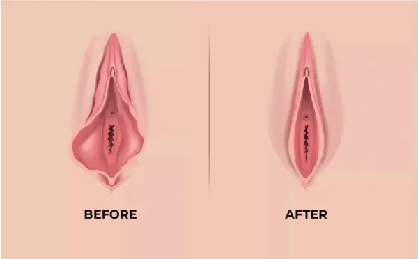  عکس و فیلم قبل و بعد از عمل لابیاپلاستی