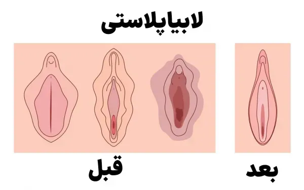  عکس و فیلم قبل و بعد از عمل لابیاپلاستی