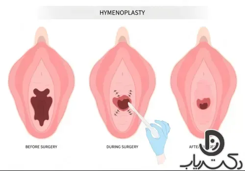  هزینه دوخت پرده بکارت