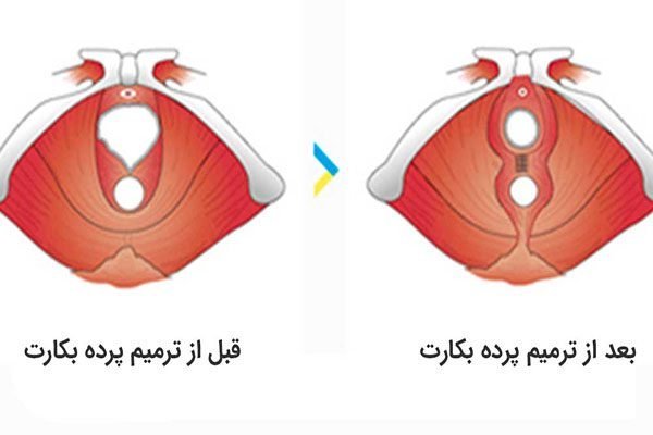  هزینه دوخت پرده بکارت