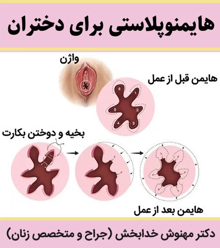  هزینه دوخت پرده بکارت