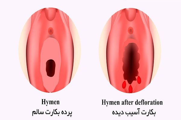  هزینه دوخت پرده بکارت